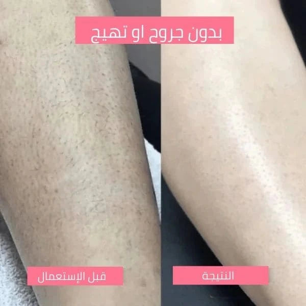 جهاز إزالة الشعر 2 في 1 – ناعم، آمن، وسهل الاستخدام